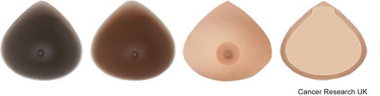 Breast - permanent prosthesis